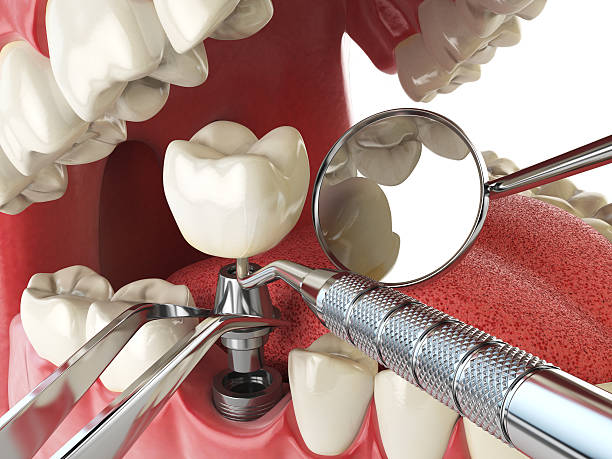 Best Emergency Treatment for Dental Infections or Abscesses in Corvallis, MT